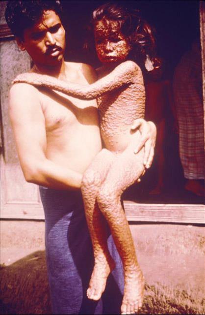 1979年12月25日人类消灭天花(2024-12-25已更新)